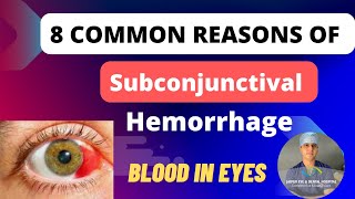 Blood in eyes  Subconjunctival Hemorrhage 8 Reasons and Treatment [upl. by Ttirb]