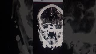 Ct brain angiography [upl. by Lucchesi]