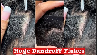 Weekly Vlog  Dry Scalp  Dandruff Removal dandruff youtuber viral contentcreator support [upl. by Adnohsak]