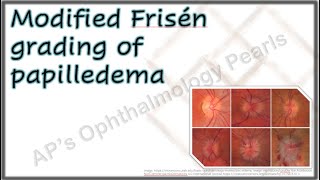 Modified Frisén Grading of Papilledema [upl. by Ludovika696]