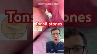 Removing tonsil stones shorts [upl. by Daveen]