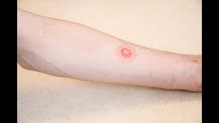 Is it ringworm Signs and symptoms [upl. by Atsyrt]