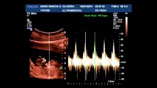 Ultrassom  Translucência Nucal  11 semanas [upl. by Kachine]