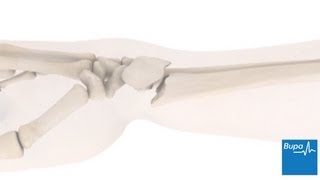 How a wrist fracture is treated  Bupa Health [upl. by Ennaitsirhc]