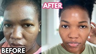 Tretinoin How I use it For A Flawless Uniform Dark Skin STOP ACNEDryMatureOilySensitive Skin [upl. by Atnahc]