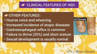 Ectodermal Dysplasia Symptoms Types Causes Diagnosis Treatment amp Life Expectancy [upl. by Karb]