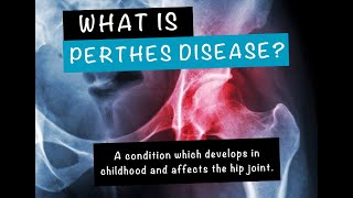 Legg CalvePerthes Disease [upl. by Wehttan726]