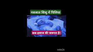 Jaundice  नवजात शिशु में पीलिया कब इलाज जरूरी हैbaby jaundice medicine mbbsinternship vmmc [upl. by Phaedra496]