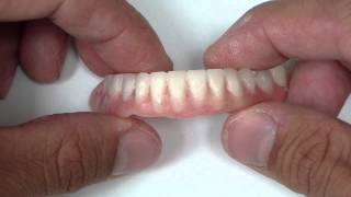 Overdenture  After Locator Pickup [upl. by Manouch]