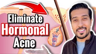 How to Get RID of Hormonal Acne  5 Ways to Treat Hormonal Acne [upl. by Ertnom302]