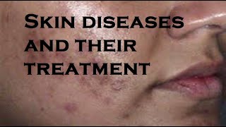 Skin diseases and their treatment [upl. by Nrubua988]