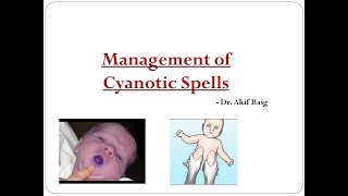 Management of cyanotic spells  Dr Akif Baig [upl. by Accire]