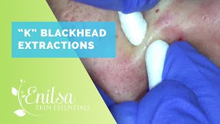 Blackhead Extractions on “K” 10 [upl. by Hanimay558]