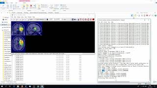 Methods in Neuropsychology Tübingen  Tutorial 2 Voxelbased statistical lesion symptom mapping [upl. by Pyotr451]