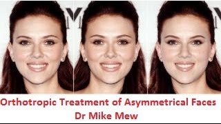 Orthotropics Treatment of Asymmetrical Disproportionate Uneven Faces by Dr MIke Mew [upl. by Anod747]