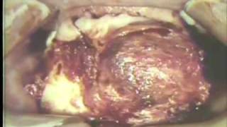 Removal of Large Ameloblastoma of Mandible [upl. by Inafit49]