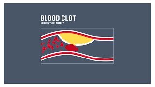 Coronary heart disease clogged arteries and atherosclerosis [upl. by Syman]