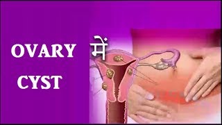 Ovary में Cyst या बच्चे न होना तो करे यह रामबांड उपाय  Ovary Cyst Treatment [upl. by Zuleika90]