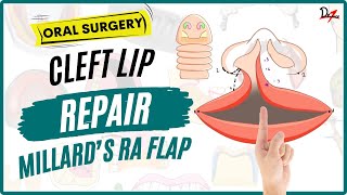 Cleft Lip Repair  Millards Rotation Advancement Flap [upl. by Naillimxam]