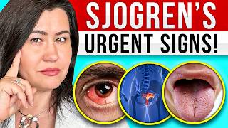 10 Signs of Sjogrens Syndrome  a very complex autoimmune disease [upl. by Ceporah]