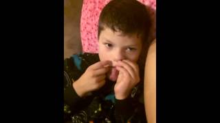 Angelman Syndrome  Constantly rubbing his face  side effects [upl. by Summons]