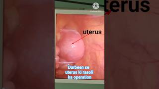 Laparoscopic myomectomy for fibroid 💉🩸fibroidlaparoscopeshortfeedviralshorttrendingshort [upl. by Lashar332]