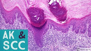 Squamous Cell Carcinoma amp Actinic Keratosis 101Dermpath Basics amp Beyond [upl. by Nednarb12]