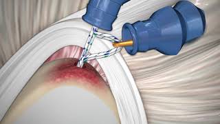 CONMED  Reparación de SLAP utilizando Anclaje de Sutura PressFT ™ [upl. by Xavler]