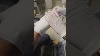 Applying a cast Fixing a broken hand in minutes [upl. by Cilegna]