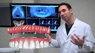 All on 4 Dental Implants Explained [upl. by Nosiddam725]