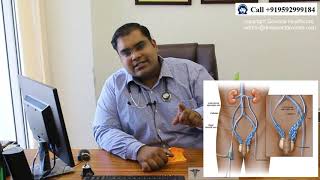 Varicocele Embolization vs Microsurgery in Hindi  Varicocele Embolization ke Nuksan aur Failure [upl. by Bruno561]