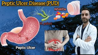 Peptic Ulcer Disease pathology  Peptic ulcer cause symptoms risk factors complication [upl. by Ilesara]