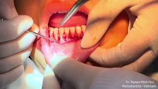 Root coverage by coronally advanced flaps CAF plus connective tissue graft CTG Step by step [upl. by Quartet]