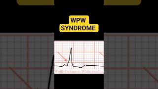 WPW SYNDROME [upl. by Yttiy]