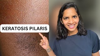 keratosis pilaris  keratosis pilaris causes  Keratosis pilaris treatment hindi [upl. by Bernita231]