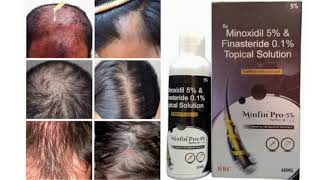 Minfin Pro 5 Topical Solution Minoxidil 5 amp Finasteride 01 Topical Solution [upl. by Ydoc]