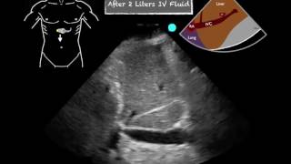 POCUS Cardiac IVC Change with fluids [upl. by Esetal]