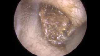 181 Ear Wax Teased amp Wriggled out to reveal Retracted Eardrum  Mr Neel Raithatha THC [upl. by Pawsner]