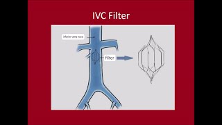 Management of DVTPulmonary Embolus [upl. by Nodnek222]