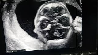 FETAL NEUROSONOGRAM TEACHING BY DR PRADEEP UNDER REFER SERIES [upl. by Tager]