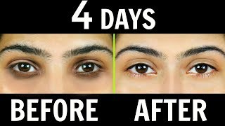 How to Remove Dark Circles Naturally in 4 Days 100 Results  Anaysa [upl. by Airakaz]