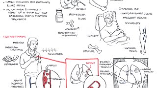 Pulmonary Embolism  Overview [upl. by Layap]