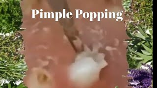 Popping Pimples and Blackheads  3 [upl. by Ariajay]