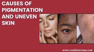 Causes of Pigmentation and Uneven Skin [upl. by Godiva]