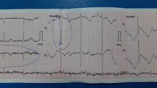 Left Ventricular Hypertrophy LVH ECG [upl. by Valenza]