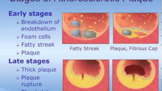 Acute Coronary Syndrome ACS  How it Happens [upl. by Ragg634]