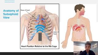 eFAST for EMS Appendix G Subxiphoid Pericardial View [upl. by Eecrad926]