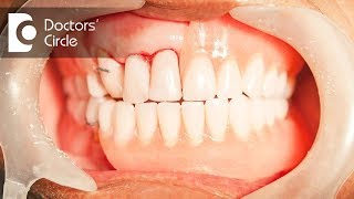 What is periodontal disease  Dr Jayaprakash Ittigi [upl. by Lerrehs]