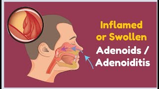 Inflamed or Swollen Adenoids  Adenoiditis [upl. by Aelyak860]