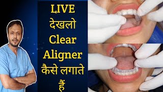 Clear Aligners कैसे लगाते हैं आज देखलो Live Patient में  Aligners duration [upl. by Ltney]